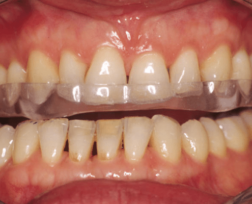 Goutiière bruxism treatment